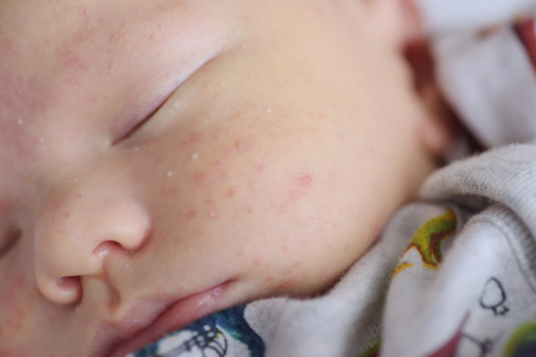 Baby Acne 101 The Natural Approach